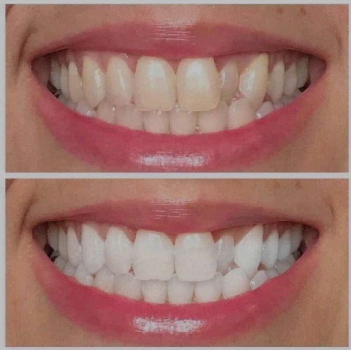 Ultraviolet Teeth Whitening Gel